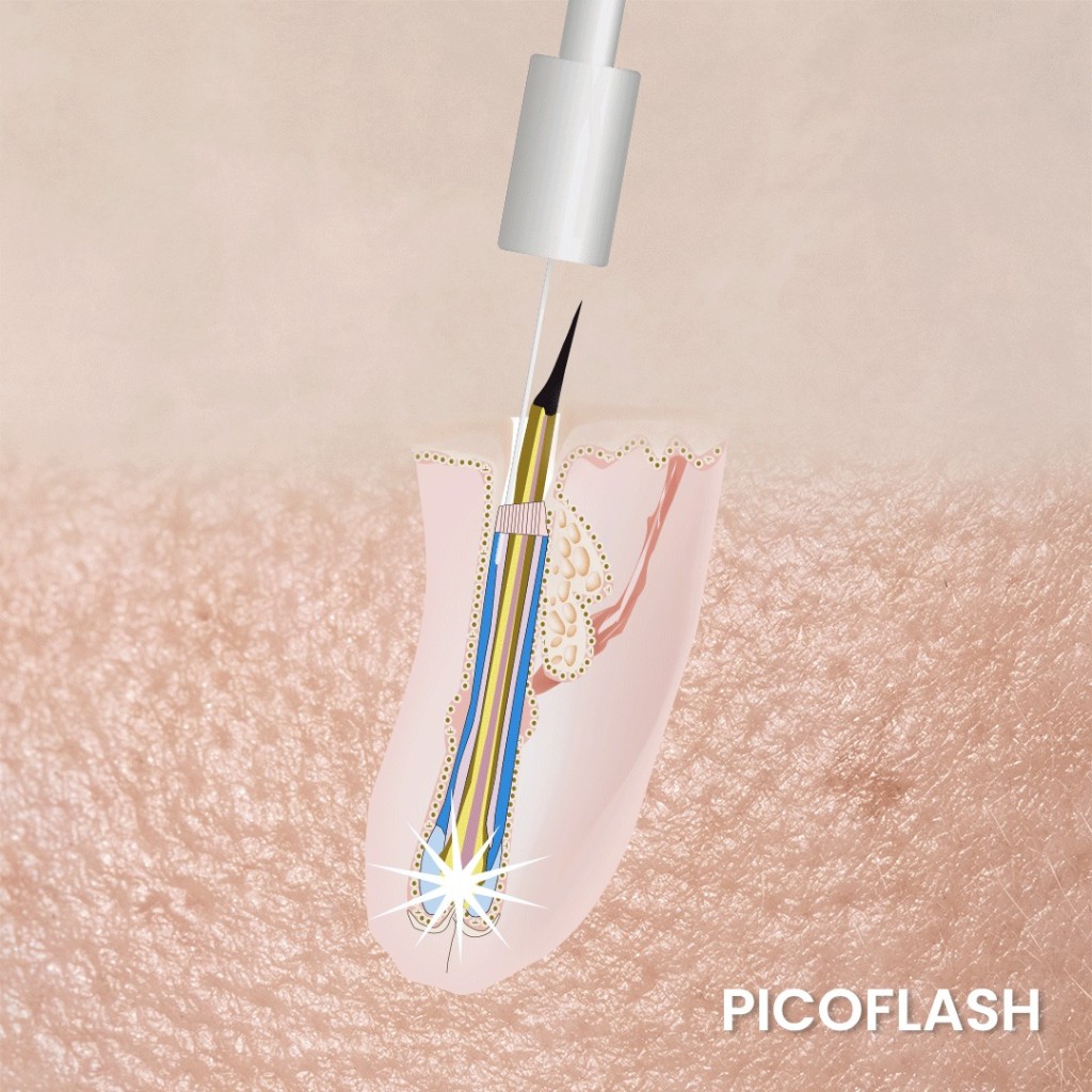 Illustration Picoflash — sonde en follicule pileux et énergie ciblée au bulbe